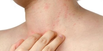 Gece Kaşıntıları Nedenleri Nelerdir?