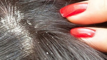 Saçta Kepek ve Kaşıntı Belirtileri ve Tedavisi