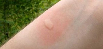 Sinek Isırığı Kaşıntısı